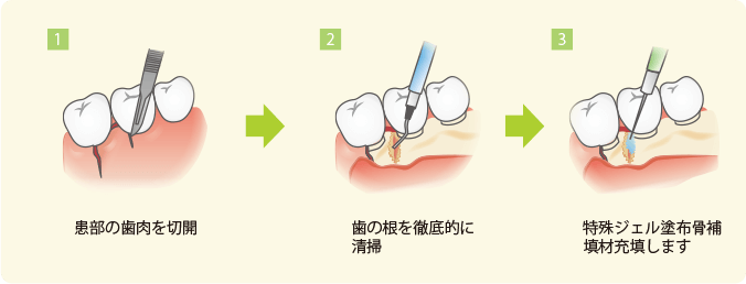 歯槽骨再生治療